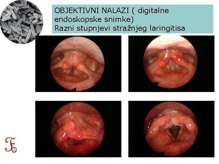 OBJEKTIVNI NALAZI ( digitalne endoskopske snimke) Razni stupnjevi stražnjeg laringitisa 