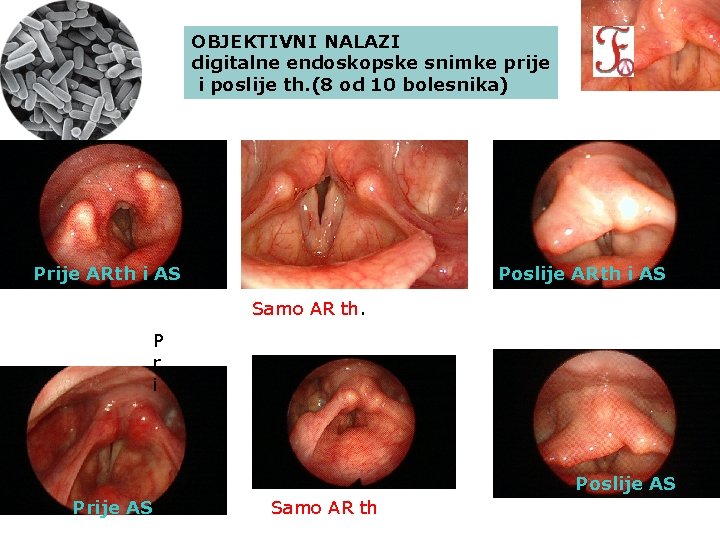 OBJEKTIVNI NALAZI digitalne endoskopske snimke prije i poslije th. (8 od 10 bolesnika) Prije