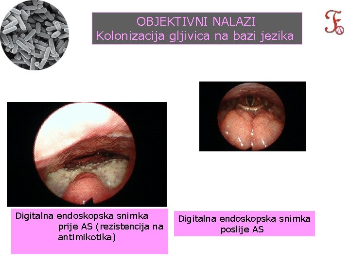 OBJEKTIVNI NALAZI Kolonizacija gljivica na bazi jezika Digitalna endoskopska snimka prije AS (rezistencija na