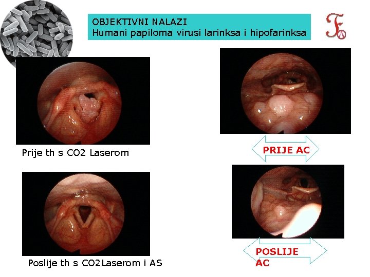 OBJEKTIVNI NALAZI Humani papiloma virusi larinksa i hipofarinksa Prije th s CO 2 Laserom