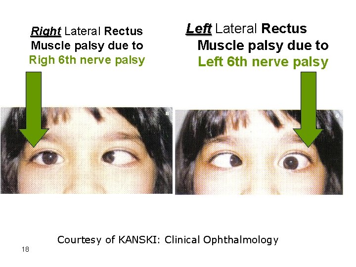 Right Lateral Rectus Muscle palsy due to Righ 6 th nerve palsy Left Lateral
