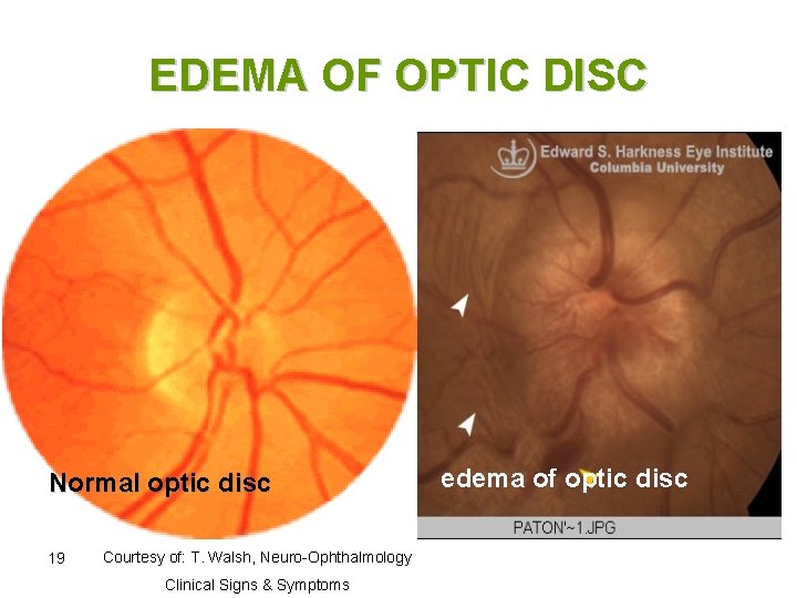 EDEMA OF OPTIC DISC Normal optic disc 19 Courtesy of: T. Walsh, Neuro-Ophthalmology Clinical
