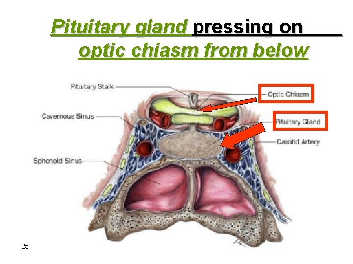 Pituitary gland pressing on optic chiasm from below 25 