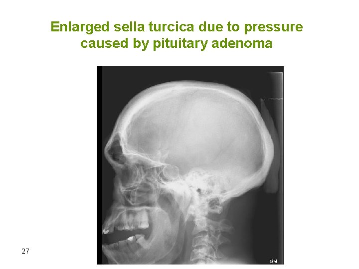 Enlarged sella turcica due to pressure caused by pituitary adenoma 27 