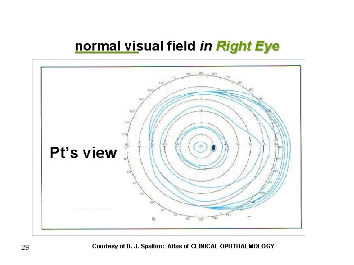 normal visual field in Right Eye Pt’s view 29 Courtesy of D. J. Spalton: