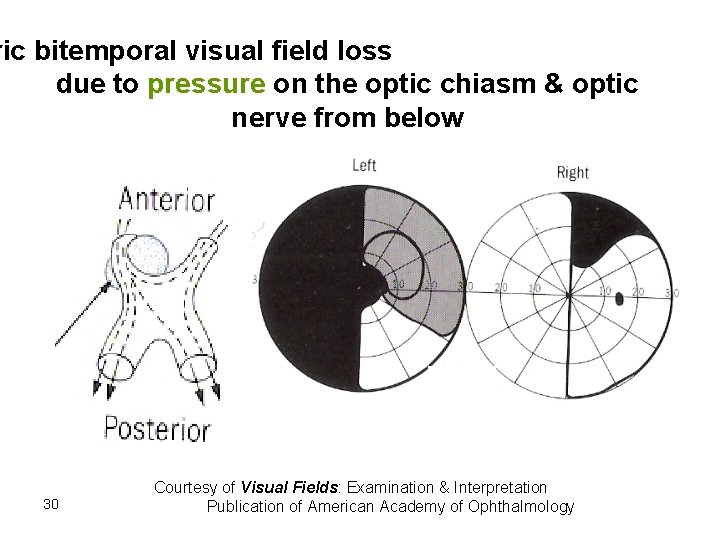 ric bitemporal visual field loss due to pressure on the optic chiasm & optic