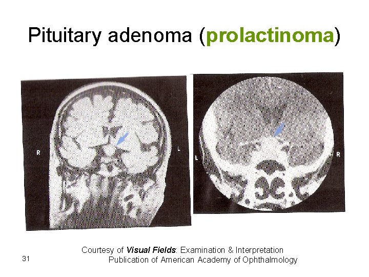 Pituitary adenoma (prolactinoma) 31 Courtesy of Visual Fields: Examination & Interpretation Publication of American