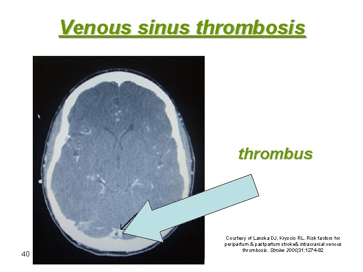 Venous sinus thrombosis thrombus 40 Courtesy of Lanska DJ, Kryscio RL. Risk factors for