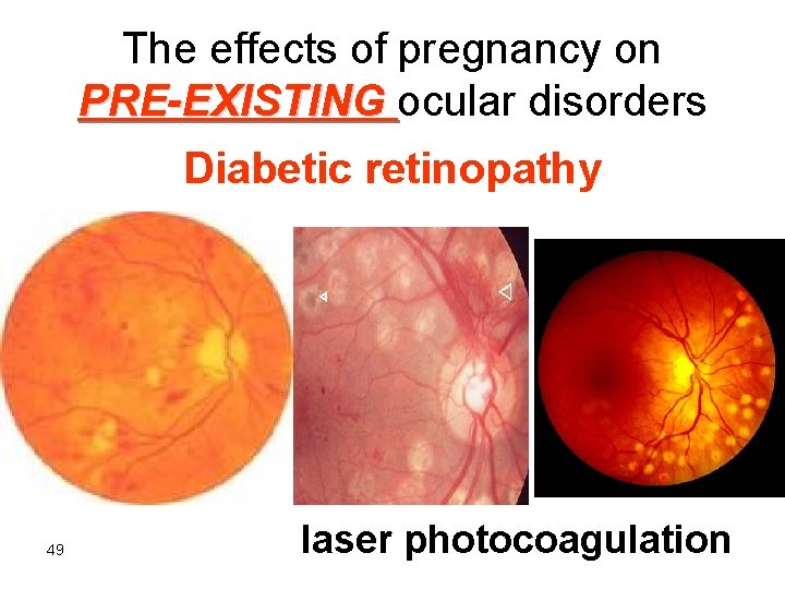 The effects of pregnancy on PRE-EXISTING ocular disorders Diabetic retinopathy 49 laser photocoagulation 