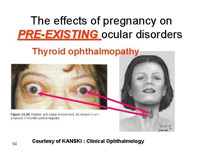 The effects of pregnancy on PRE-EXISTING ocular disorders Thyroid ophthalmopathy 54 Courtesy of KANSKI