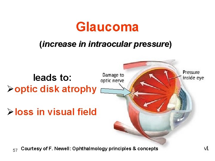 Glaucoma (increase in intraocular pressure) pressure leads to: Øoptic disk atrophy Øloss in visual