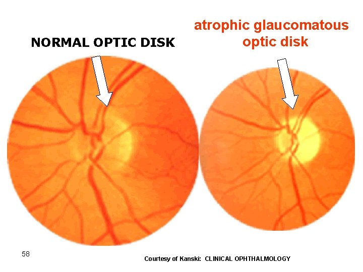 NORMAL OPTIC DISK 58 atrophic glaucomatous optic disk Courtesy of Kanski: CLINICAL OPHTHALMOLOGY 