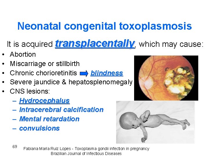 Neonatal congenital toxoplasmosis It is acquired transplacentally, which may cause: • • • Abortion