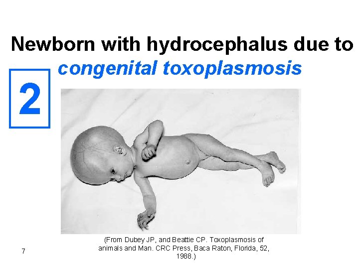 Newborn with hydrocephalus due to congenital toxoplasmosis 2 7 (From Dubey JP, and Beattie