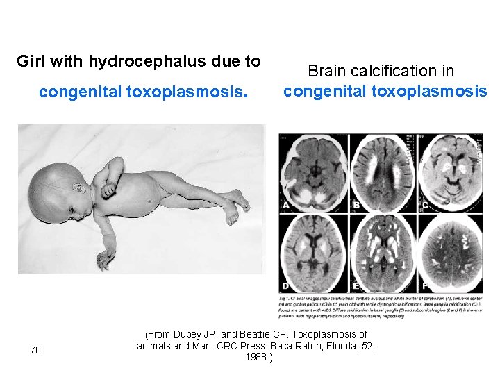 Girl with hydrocephalus due to congenital toxoplasmosis. 70 Brain calcification in congenital toxoplasmosis (From