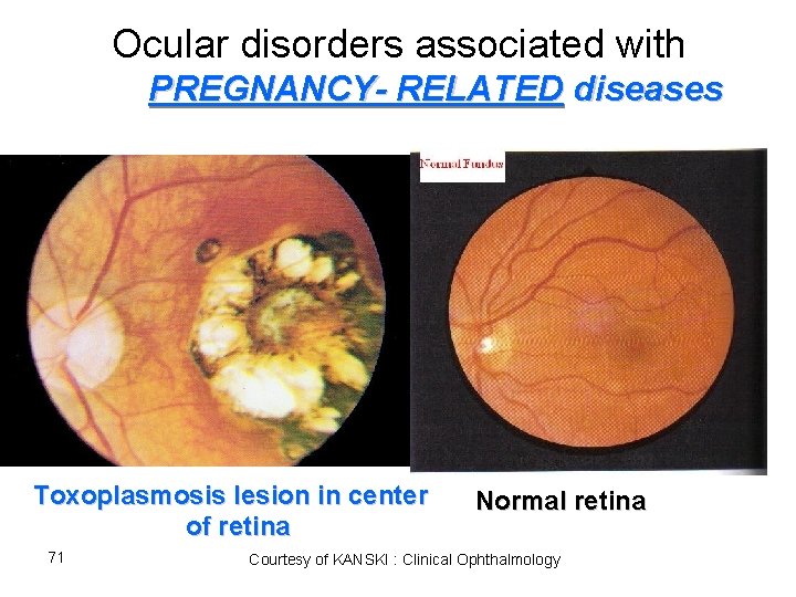 Ocular disorders associated with PREGNANCY- RELATED diseases Toxoplasmosis lesion in center of retina 71