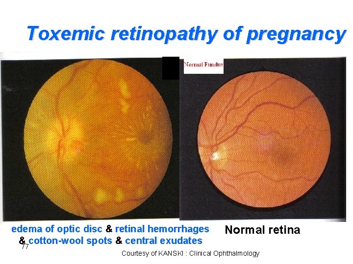 Toxemic retinopathy of pregnancy edema of optic disc & retinal hemorrhages & cotton-wool spots