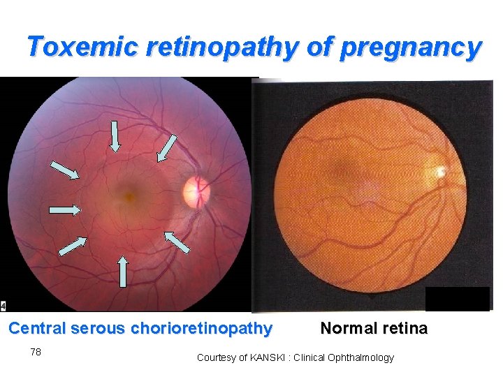 Toxemic retinopathy of pregnancy Central serous chorioretinopathy 78 Normal retina Courtesy of KANSKI :