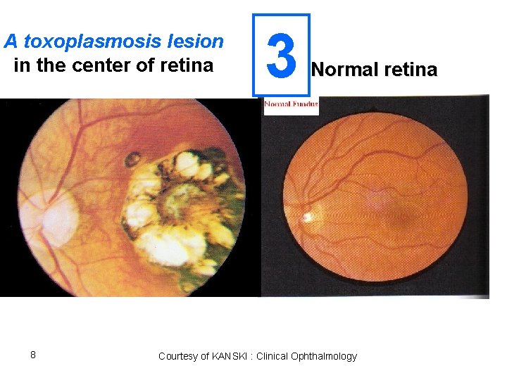 A toxoplasmosis lesion in the center of retina 8 3 Normal retina Courtesy of