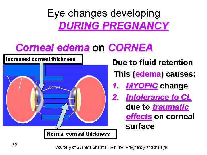 Eye changes developing DURING PREGNANCY Corneal edema on CORNEA Increased corneal thickness Due to