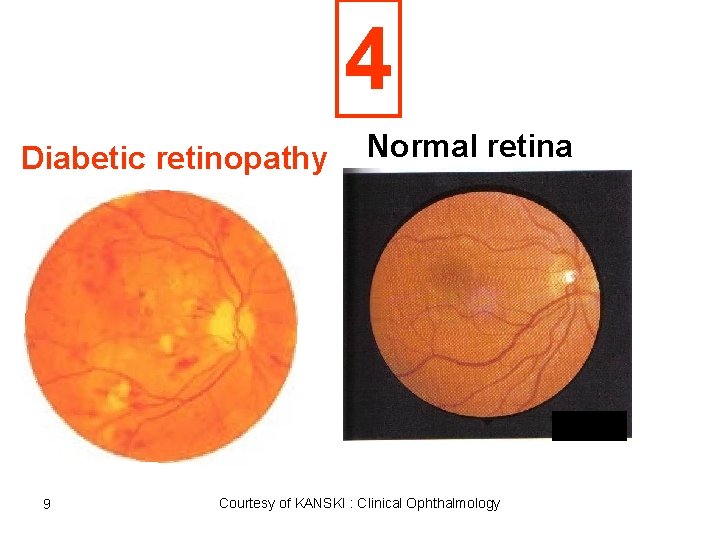4 Diabetic retinopathy 9 Normal retina Courtesy of KANSKI : Clinical Ophthalmology 