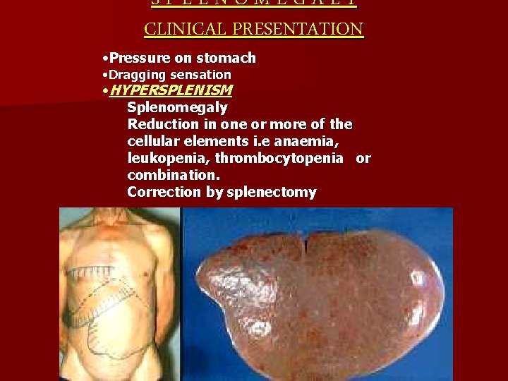 SPLENOMEGALY CLINICAL PRESENTATION • Pressure on stomach • Dragging sensation • HYPERSPLENISM Splenomegaly Reduction