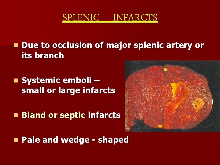 SPLENIC INFARCTS n Due to occlusion of major splenic artery or its branch n