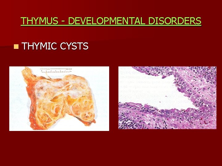 THYMUS - DEVELOPMENTAL DISORDERS n THYMIC CYSTS 