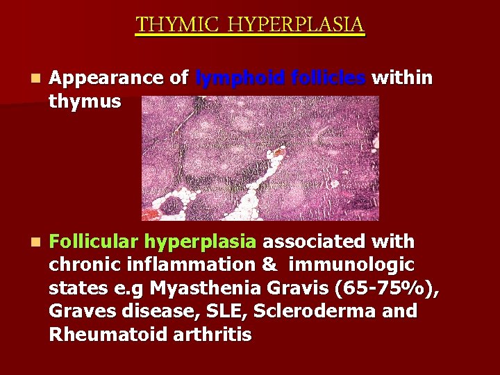 THYMIC HYPERPLASIA n Appearance of lymphoid follicles within thymus n Follicular hyperplasia associated with