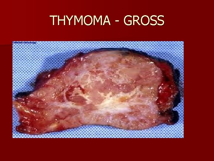 THYMOMA - GROSS 