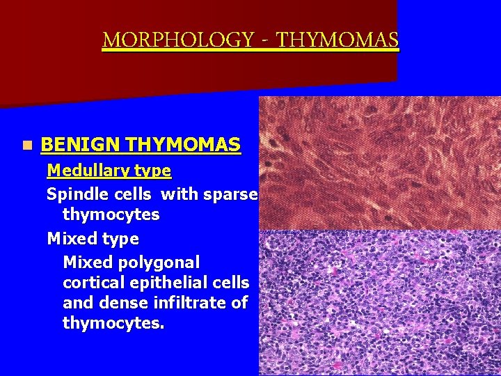MORPHOLOGY - THYMOMAS n BENIGN THYMOMAS Medullary type Spindle cells with sparse thymocytes Mixed