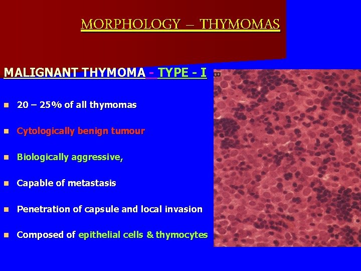 MORPHOLOGY – THYMOMAS MALIGNANT THYMOMA - TYPE - I n 20 – 25% of