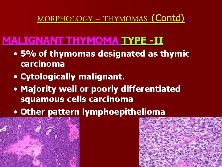 MORPHOLOGY – THYMOMAS (Contd) MALIGNANT THYMOMA TYPE -II • 5% of thymomas designated as