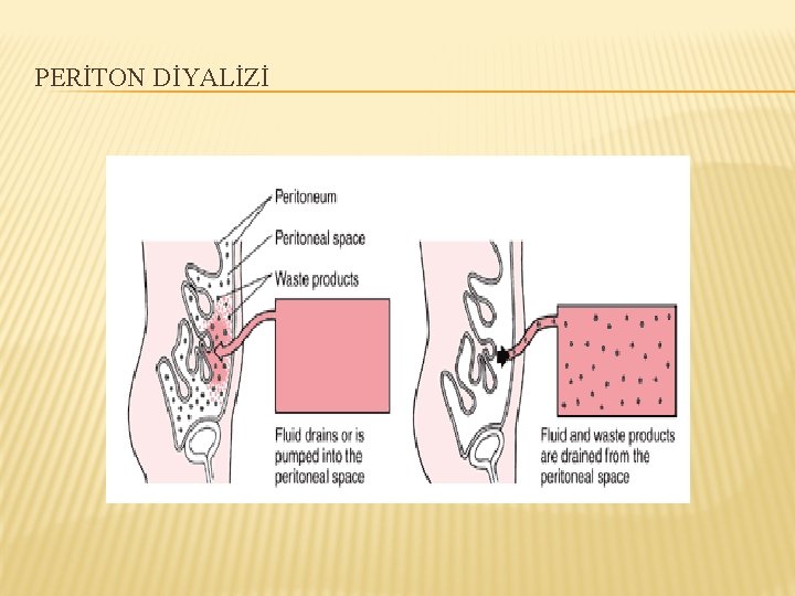 PERİTON DİYALİZİ 