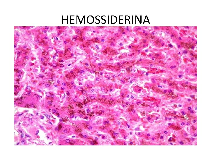 HEMOSSIDERINA 