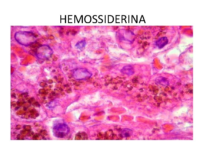 HEMOSSIDERINA 