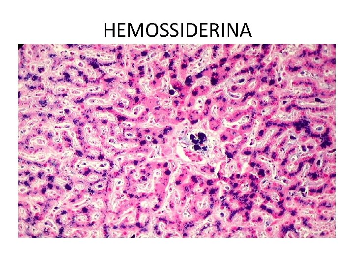 HEMOSSIDERINA 