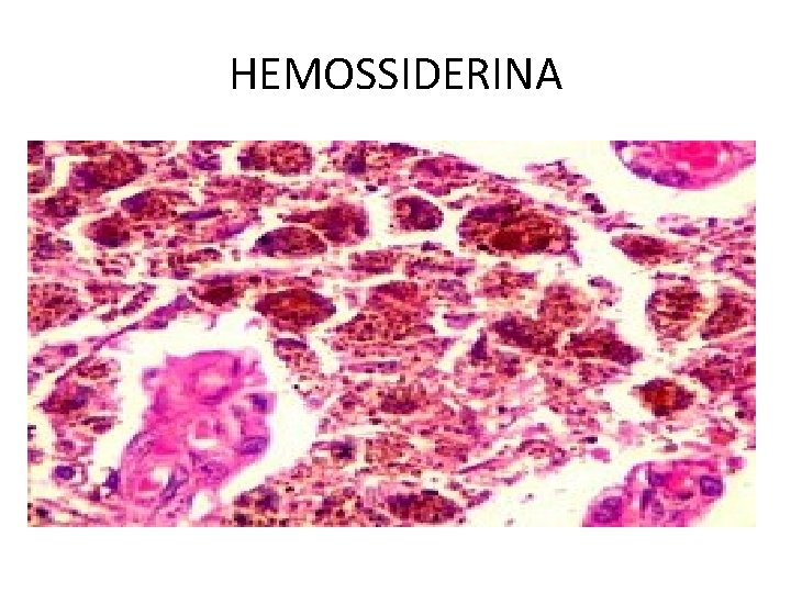 HEMOSSIDERINA 