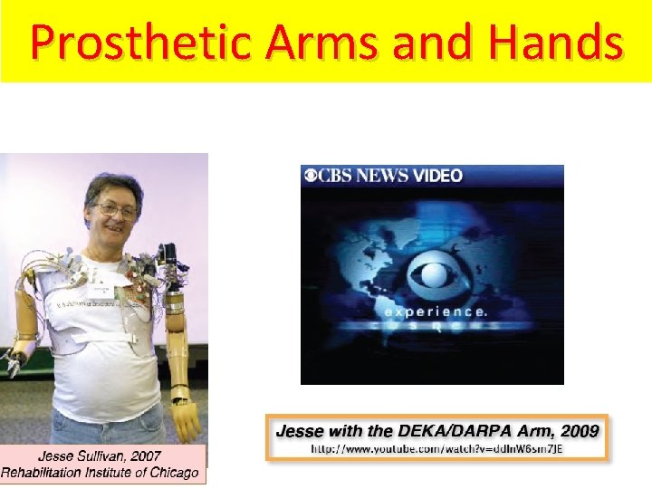 Prosthetic Arms and Hands 