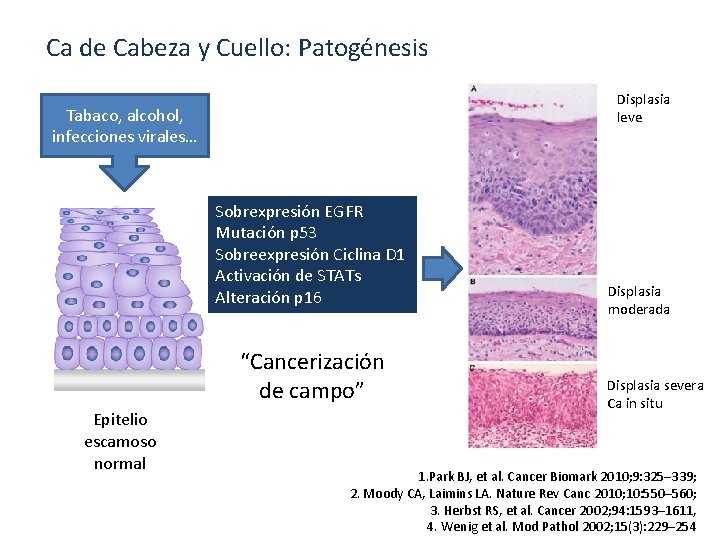 Ca de Cabeza y Cuello: Patogénesis Displasia leve Tabaco, alcohol, infecciones virales… Sobrexpresión EGFR Ca de Cabeza y Cuello: Patogénesis Displasia leve Tabaco, alcohol, infecciones virales… Sobrexpresión EGFR