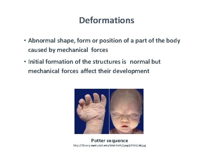 Deformations • Abnormal shape, form or position of a part of the body caused