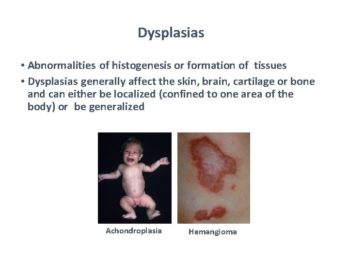 Dysplasias • Abnormalities of histogenesis or formation of tissues • Dysplasias generally affect the