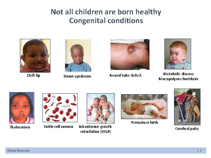 Not all children are born healthy Congenital conditions Cleft lip Thalassemia Global Overview Down