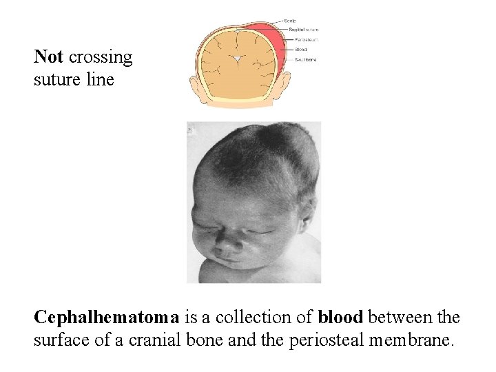 Not crossing suture line Cephalhematoma is a collection of blood between the surface of