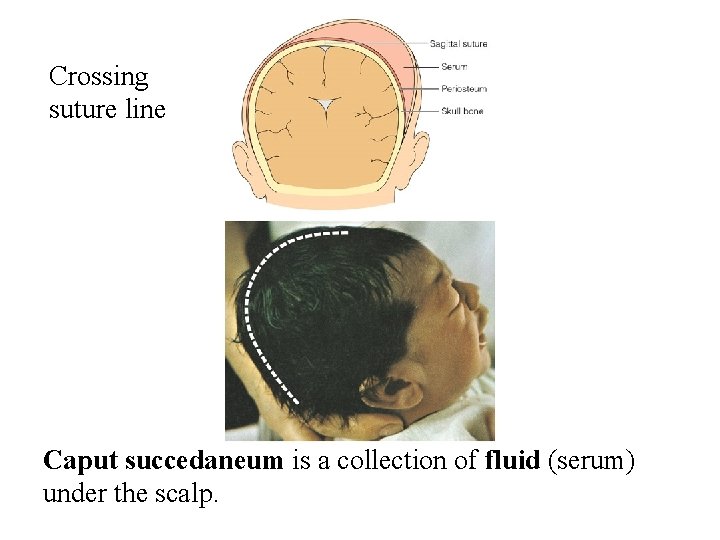 Crossing suture line Caput succedaneum is a collection of fluid (serum) under the scalp.