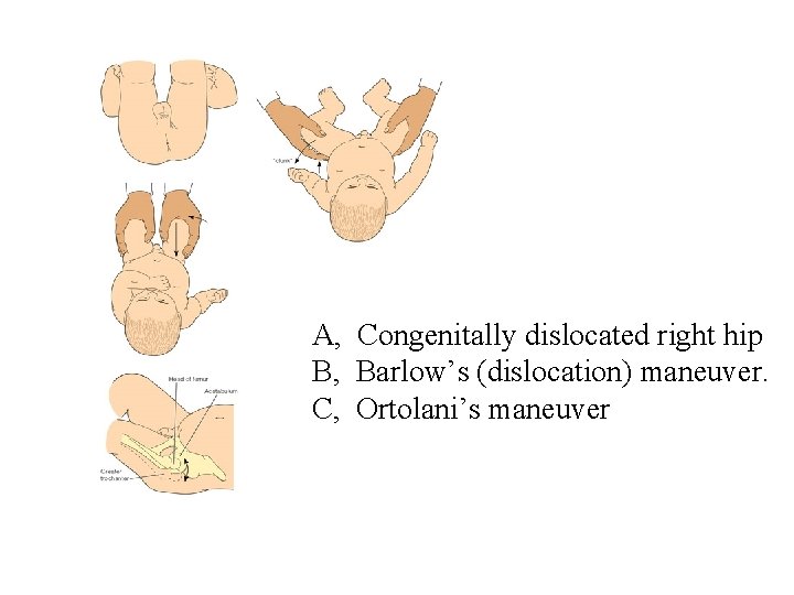 A, Congenitally dislocated right hip B, Barlow’s (dislocation) maneuver. C, Ortolani’s maneuver 