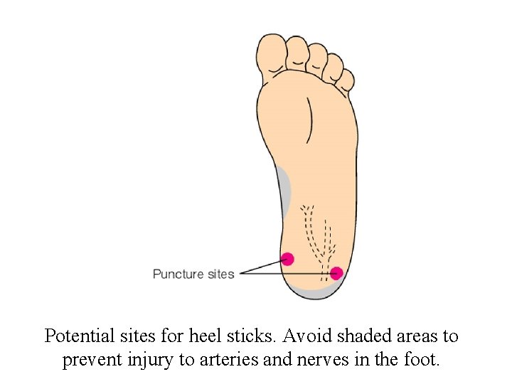 Potential sites for heel sticks. Avoid shaded areas to prevent injury to arteries and