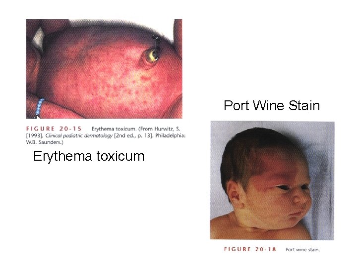Port Wine Stain Erythema toxicum 