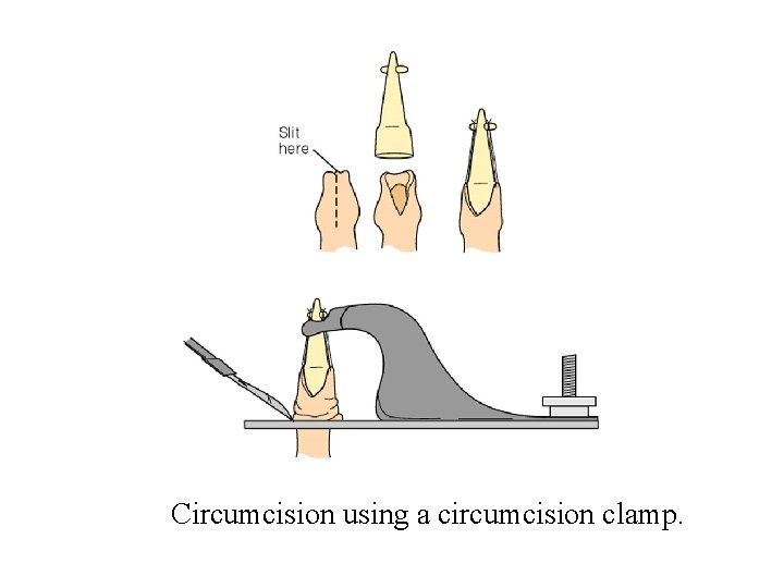 Circumcision using a circumcision clamp. 