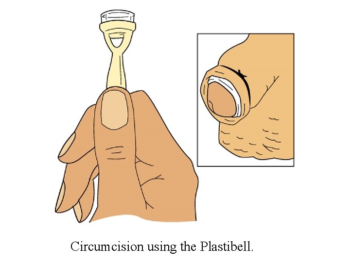 Circumcision using the Plastibell. 